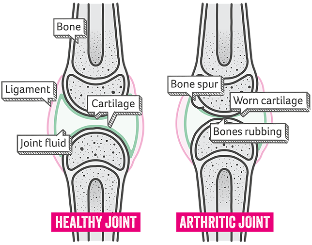 Illustration of a diagram showing a healthy joint and an arthritic joint side-by-side